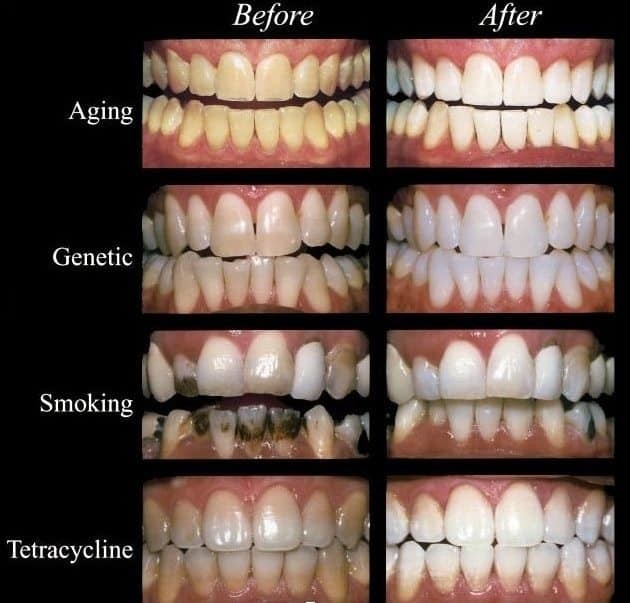 more teeth whitening