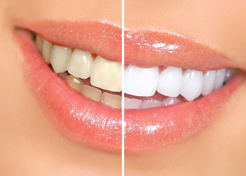 Teeth Whitening Simcoe