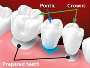 Fixed dental bridge 2