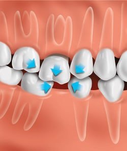 Teeth Crowding