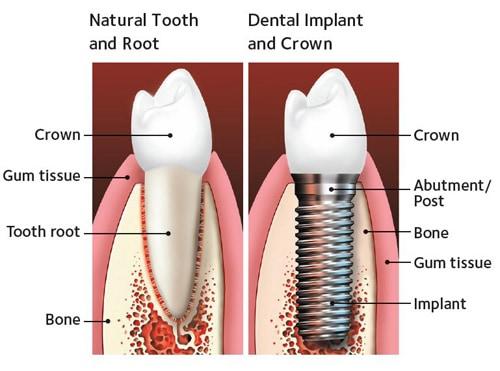 Single tooth implant